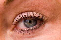 Veines dilatées et plus vascularisées dans les yeux bleus