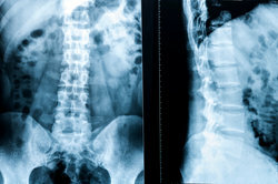 La colonna vertebrale offre molti punti di partenza per le malattie degenerative.