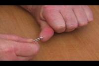 ビデオ：指の破片を取り除く方法