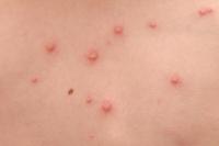 Taking a shower with chickenpox?
