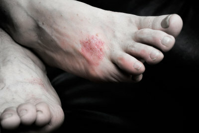 Psoriasis can appear all over the body.