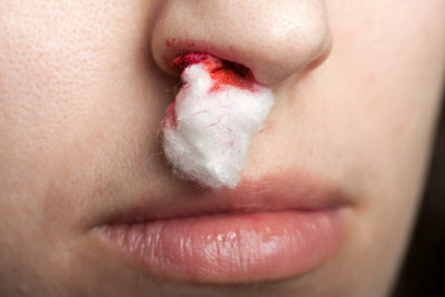 Česta krvarenja iz nosa kod djece trebaju pregledati liječnici.