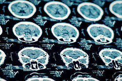 När en stroke inträffar påverkas hjärnan.