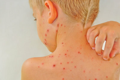 La varicella è trasmessa da un virus dell'herpes.