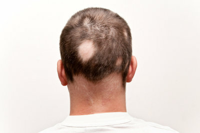 Домашние средства могут остановить выпадение волос.