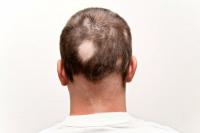 Use home remedies for hair loss effectively