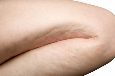 You can simply remove cellulite.