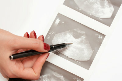 Identify the ovaries on ultrasound