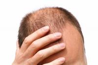 Šukuosena gerai padengia besitraukiančią plaukų liniją