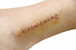 The treatment of the scar determines its appearance.