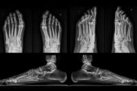 Rotto: proteggere il dito del piede nella vita di tutti i giorni