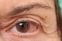 Jak dostanete oční infekci?
