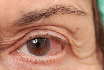 Καλύτερα να χρησιμοποιείτε οφθαλμικές σταγόνες χωρίς φακούς επαφής.