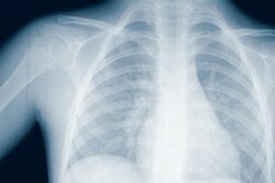 Zapalenie płuc wywołują bakterie, rzadziej wirusy.