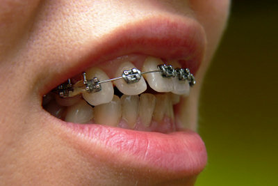 Some of the costs for the braces will be covered.