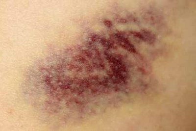 If you have a bruise, there are several things you can do to speed up the healing process.